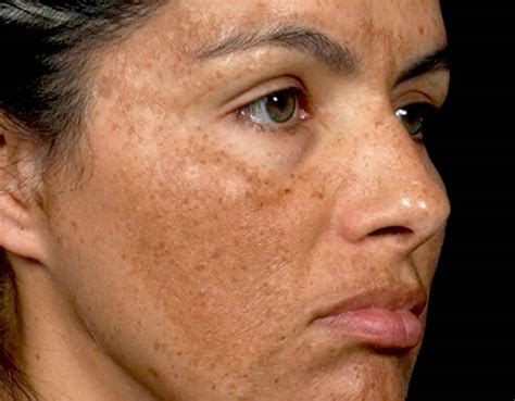 臉頰黑斑|黑斑 (Melasma)